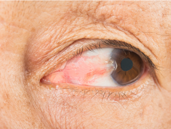 Pterygium Evaluation