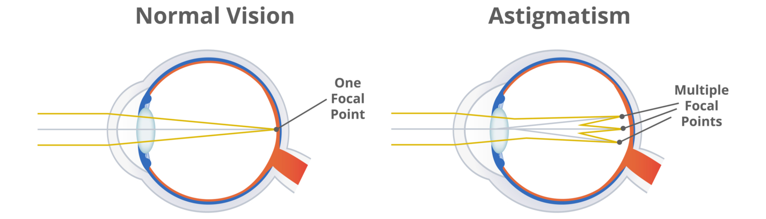 Astigmatism, refractive or refraction error. Eye disorder, eye does not focus light evenly on the retina. Blurry, blurred, or distorted vision. The illustration is isolated on a white background.