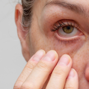 Cropped woman face with fingers under eye showing redness in eye