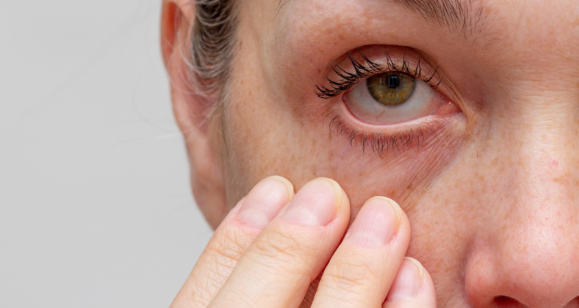 Cropped woman face with fingers under eye showing redness in eye