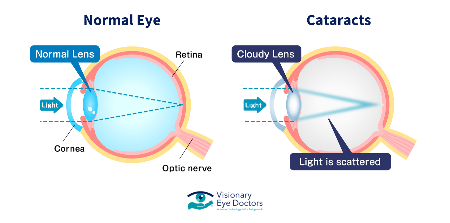 Normal Eye vs cataract