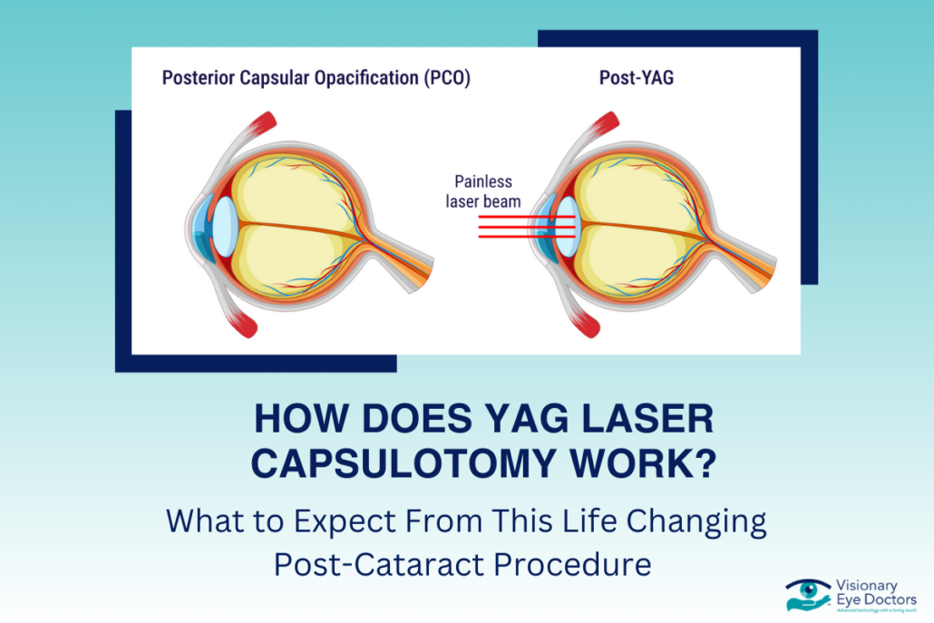 Can Cataracts Come Back? Learn About Secondary Cataracts & Treatment