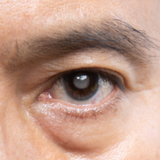 Senior man has cataracts. Generally, cataracts are common in older people.