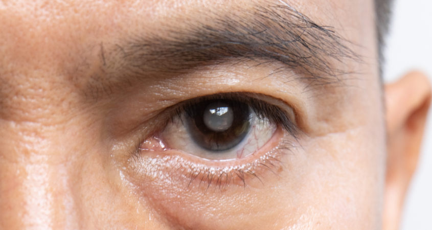 Can Cataracts Come Back? Learn About Secondary Cataracts & Treatment