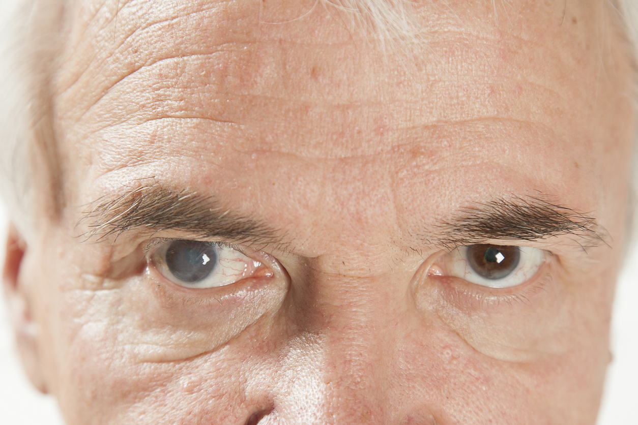 Defeat of the right eye of a man with glaucoma and cataracts is 100%. The initial stage of cataract and glaucoma of the left eye in an elderly man.