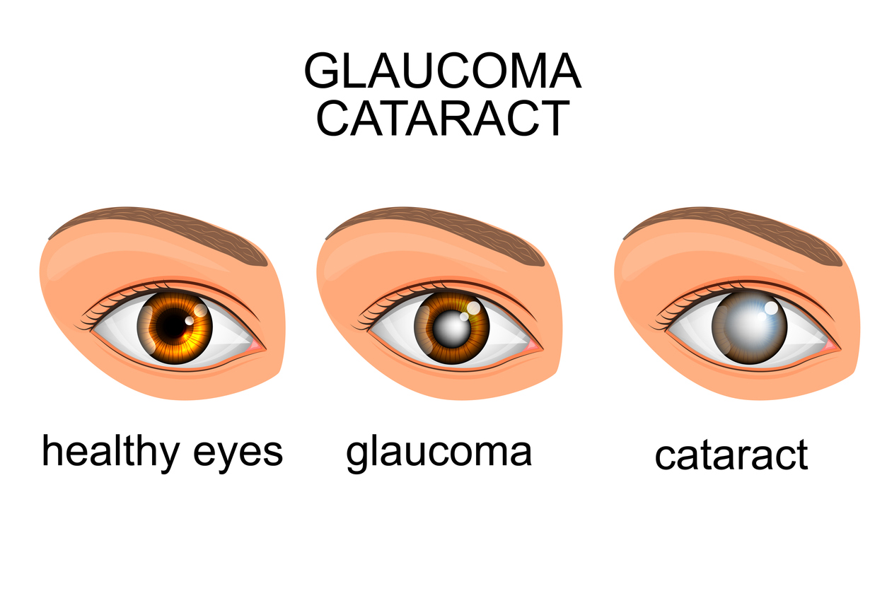 vector illustration of a healthy eye, glaucoma, cataract