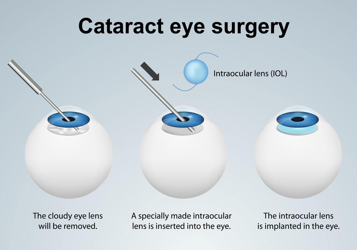 cataract eye surgery process medical vector illustration isolated on grey background eps 10 infographic