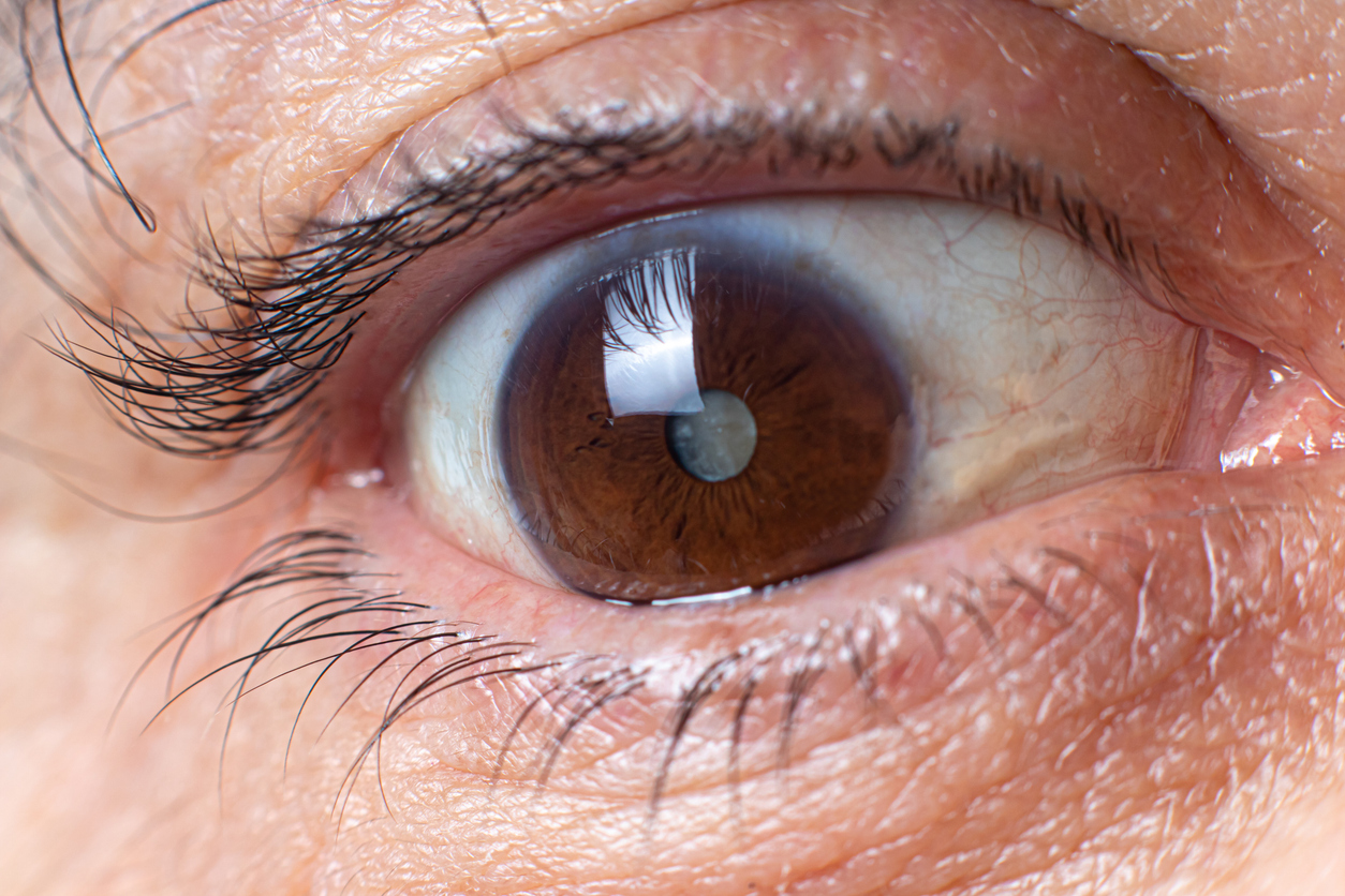 Macro photos of the human eye - cataract clouding of the lens, deterioration of vision.