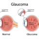 glaucoma graphic