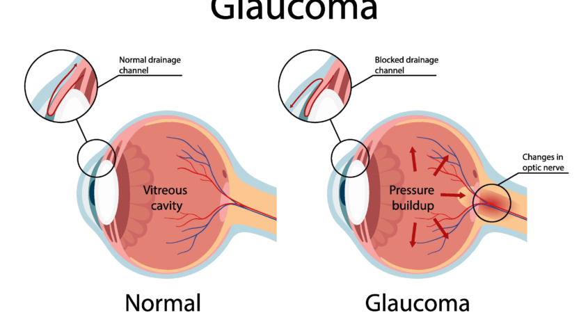 glaucoma graphic