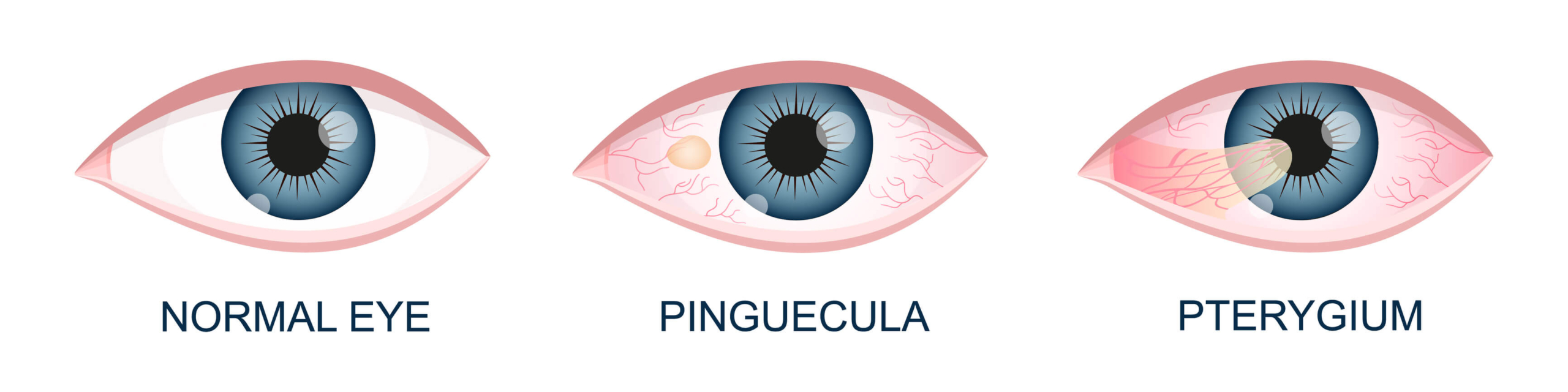 normal eye vs pterygium vs pinguecula